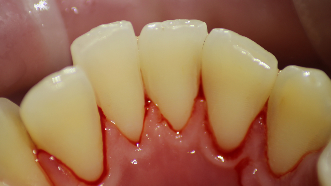 Фото зубов после лечения гингивита