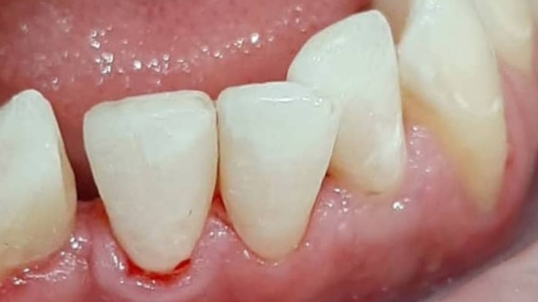 Фото кариеса 3-х зубов после лечения