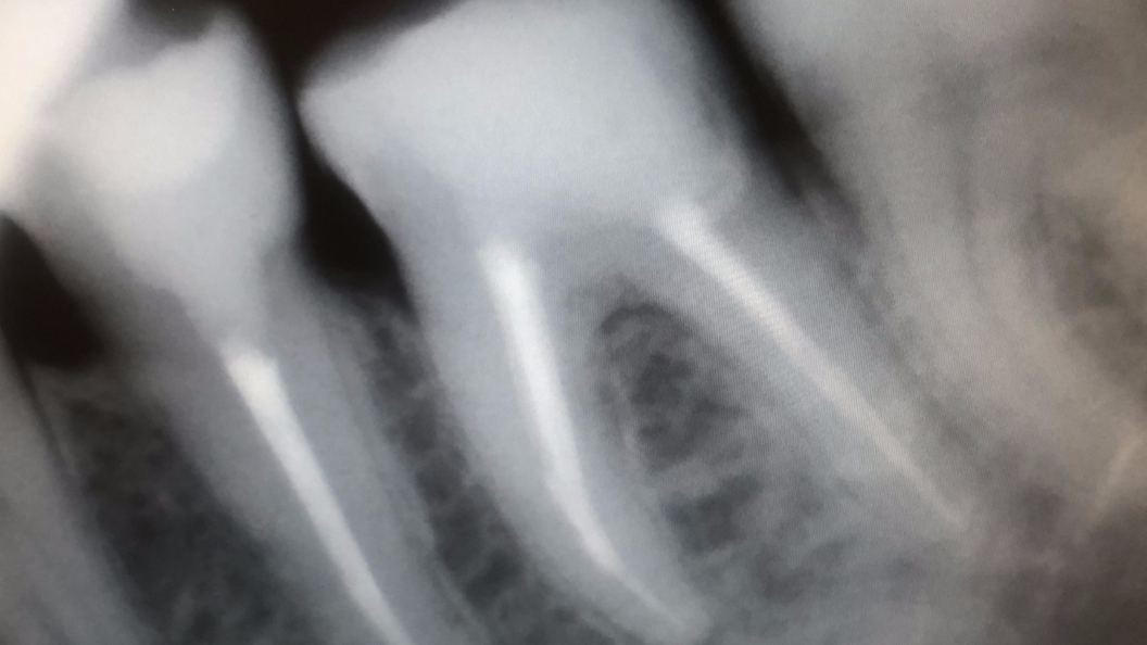 Фото 3.6 зуба после лечения
