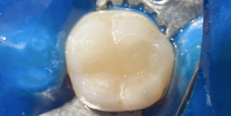 Фото зуба после реставрации