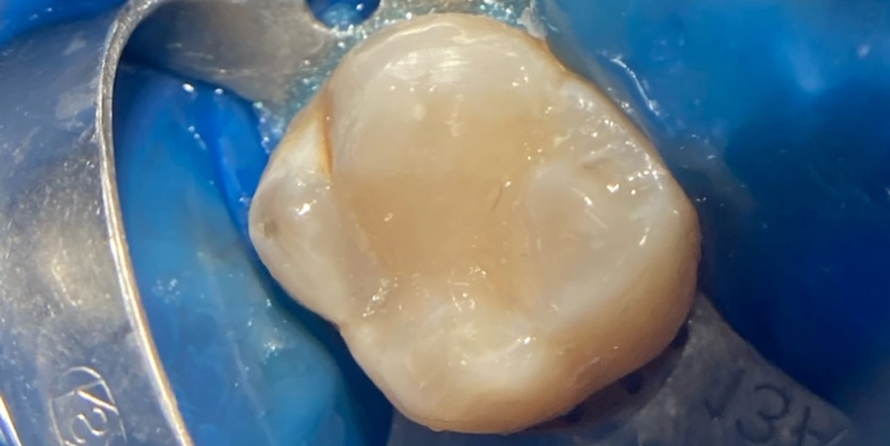 Фото зуба после установки пломбы