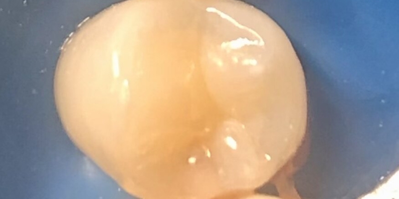 Фото зуба 4.5 после лечения кариеса
