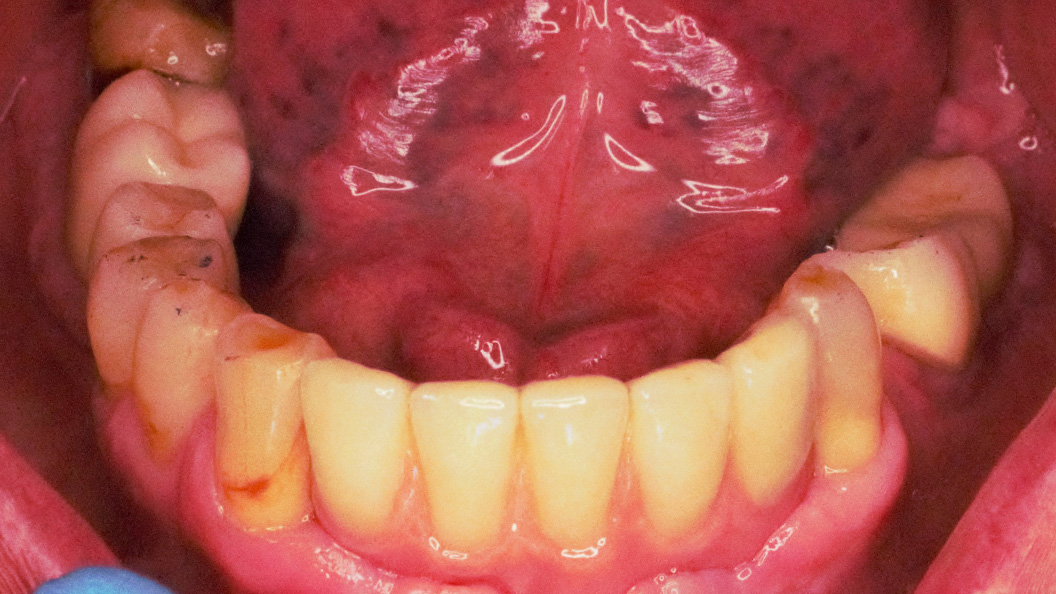 Фото имплантов на нижних зубах
