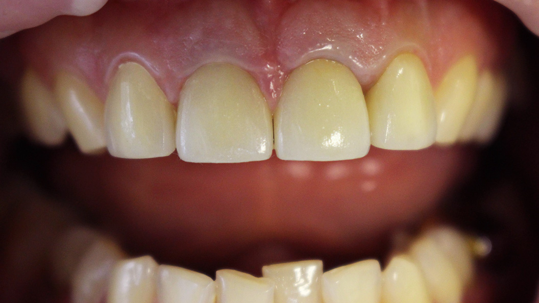 Фото зубов с циркониевыми коронками