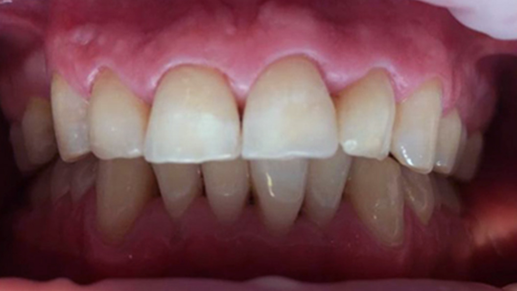 Фото переднего зуба после реставрации