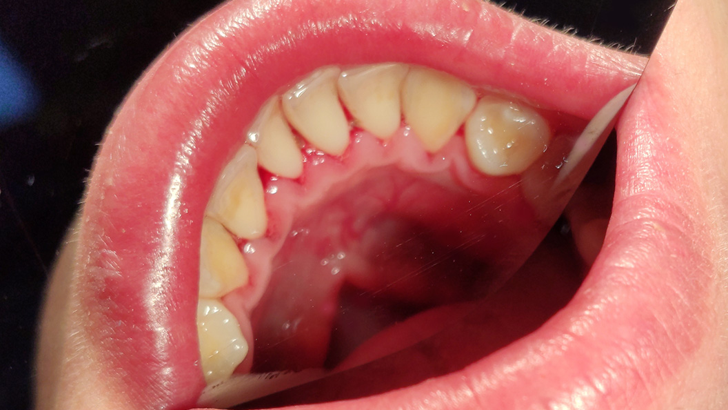 Зубы после удаления зубных отложений