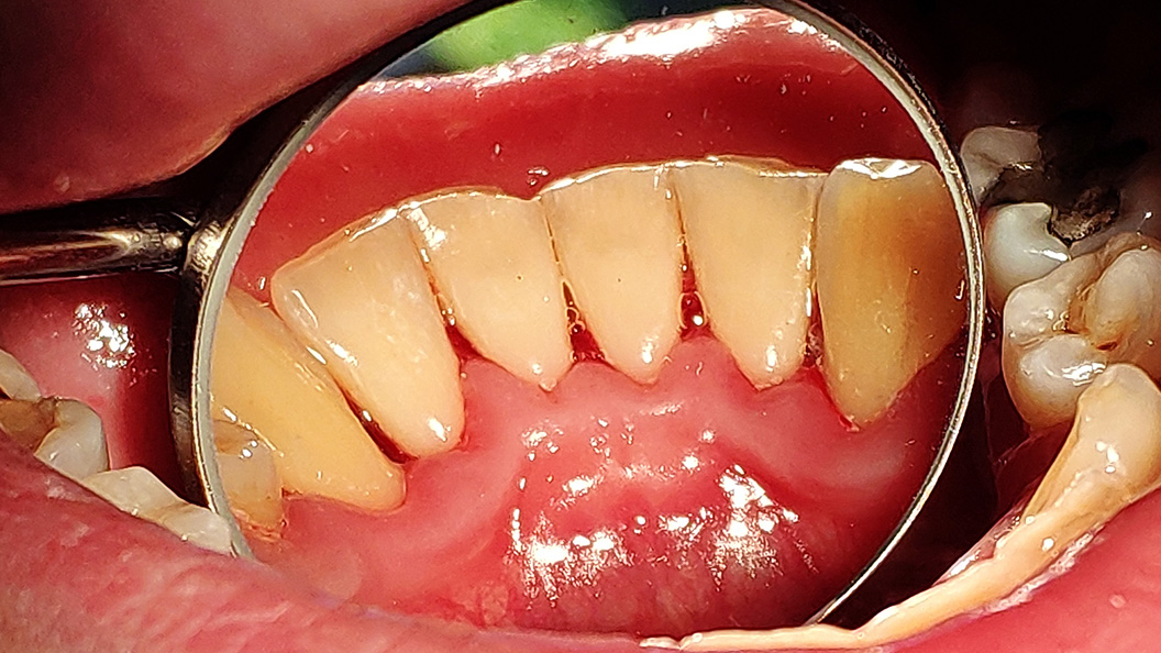 Фото зубов после профессиональной гигиены