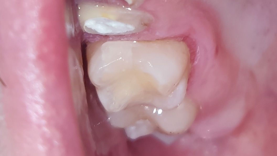 Зуб после лечения переднего кариеса