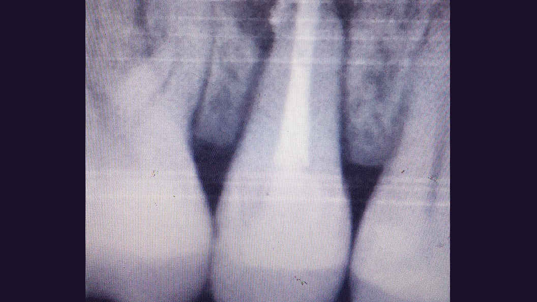 Снимок зубов после лечения периодонтита