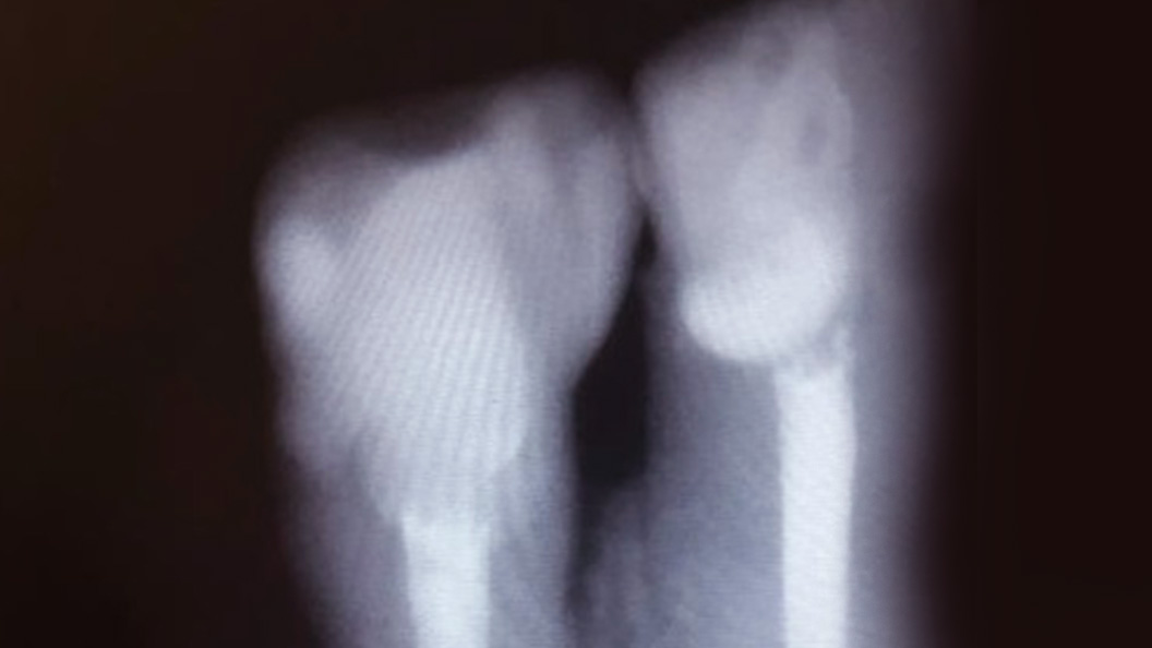Фото зуба после лечения хронического пульпита
