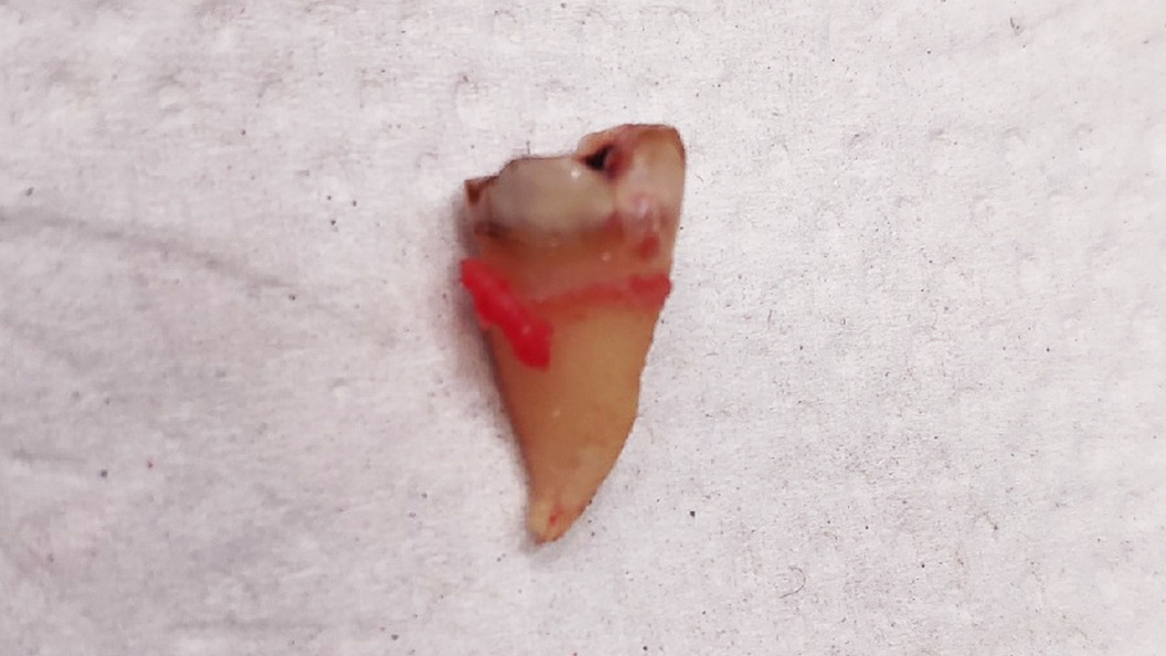 Фото удаленного зуба