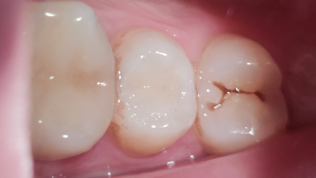 Фото зуба после лечения кариеса