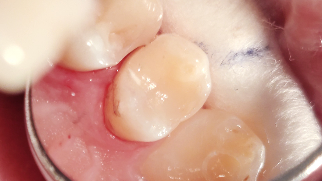 Фото зуба после лечения среднего кариеса