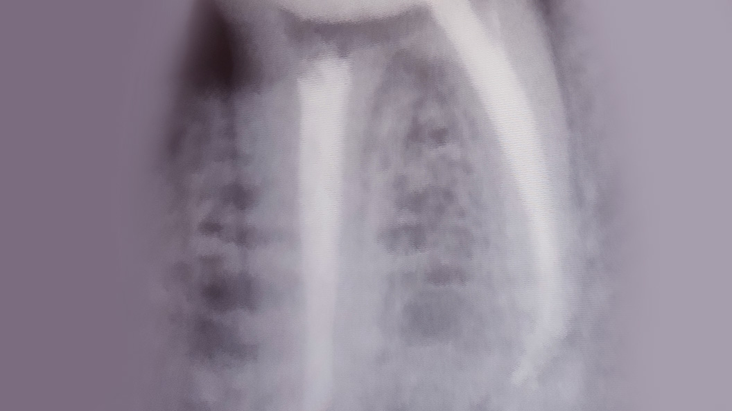 Снимок зуба после эндодонтического лечения