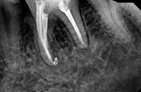 Снимок зуба после лечения периодонтита