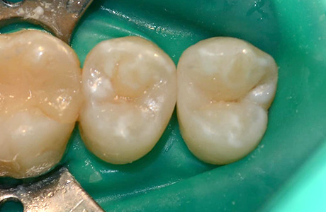 Фото кариеса зуба после лечения