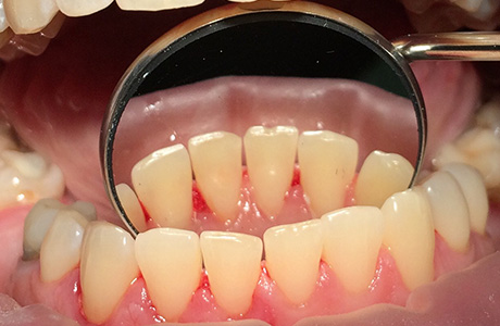 Зубы после чистки и осветления эмали