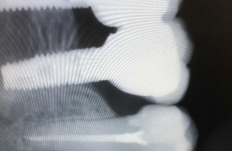 Снимок зуба после лечения пульпита