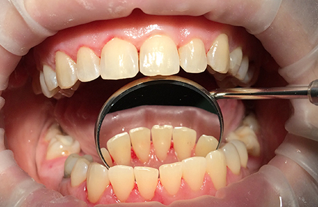 Фото зубов после профгигиены