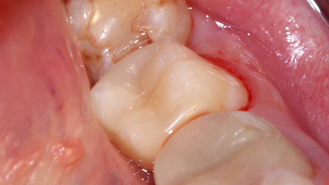 Фото зуба после лечения кариеса