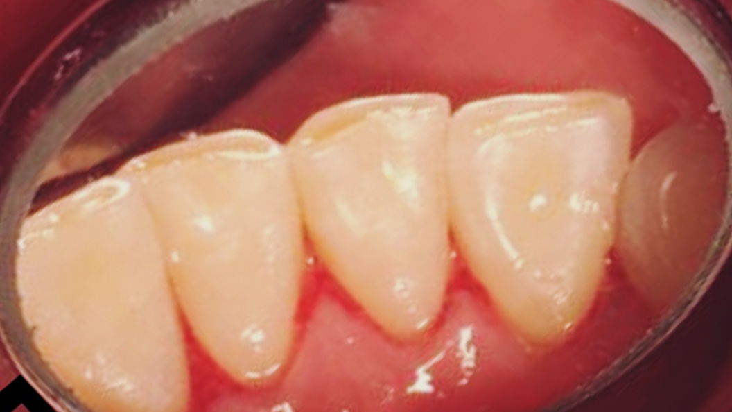 Фото зубов после устранения налета