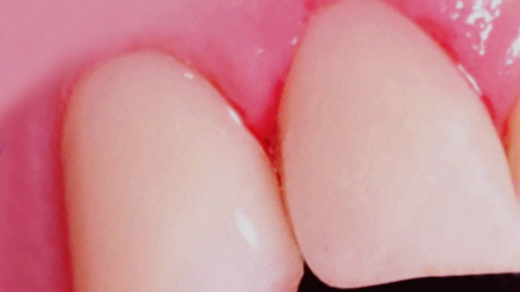 Передние зубы после лечения