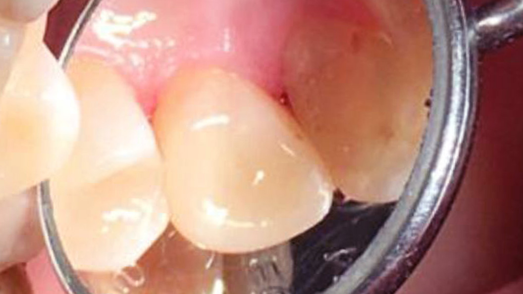 Фото переднего зуба после лечения