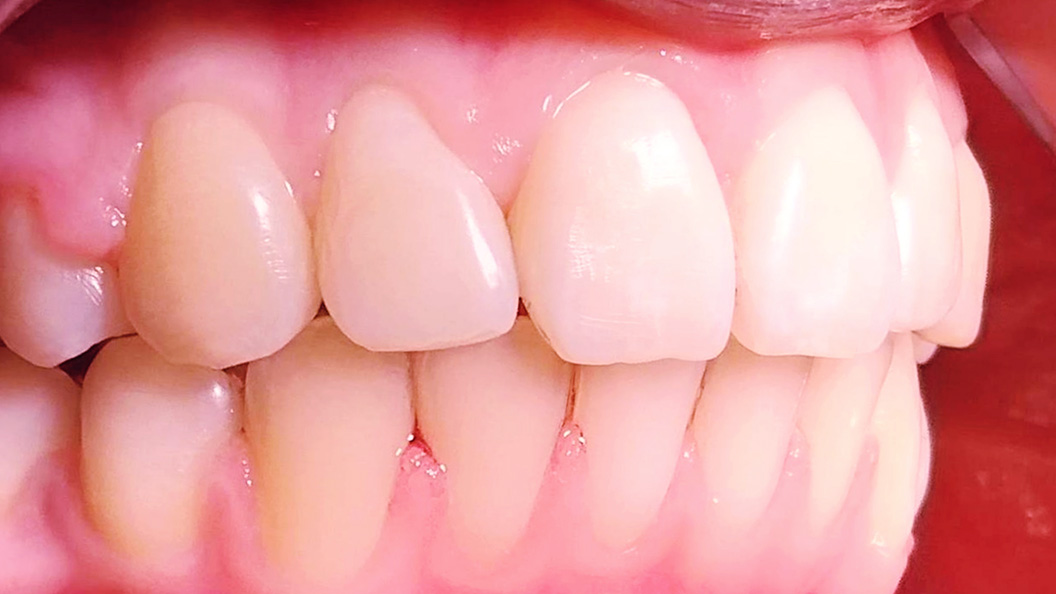 Фото скрученности зубов после лечения