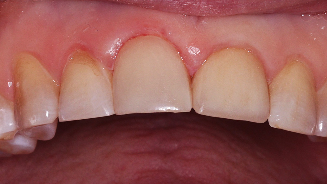 Фото зуба после устранения дисплазии