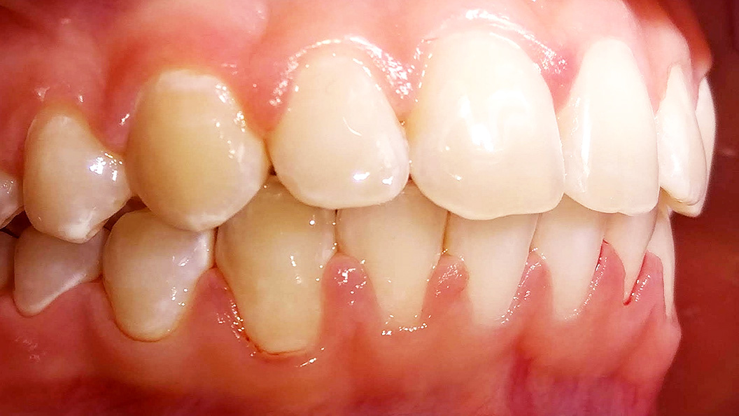 Фото зубов после установки брекетов