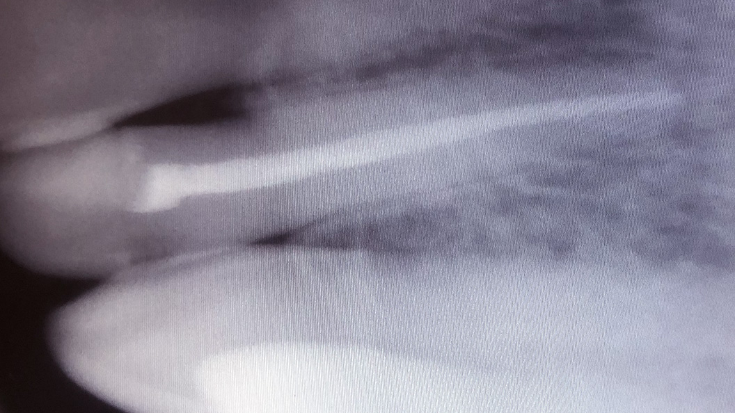 Снимок зуба после лечения хронического пульпита