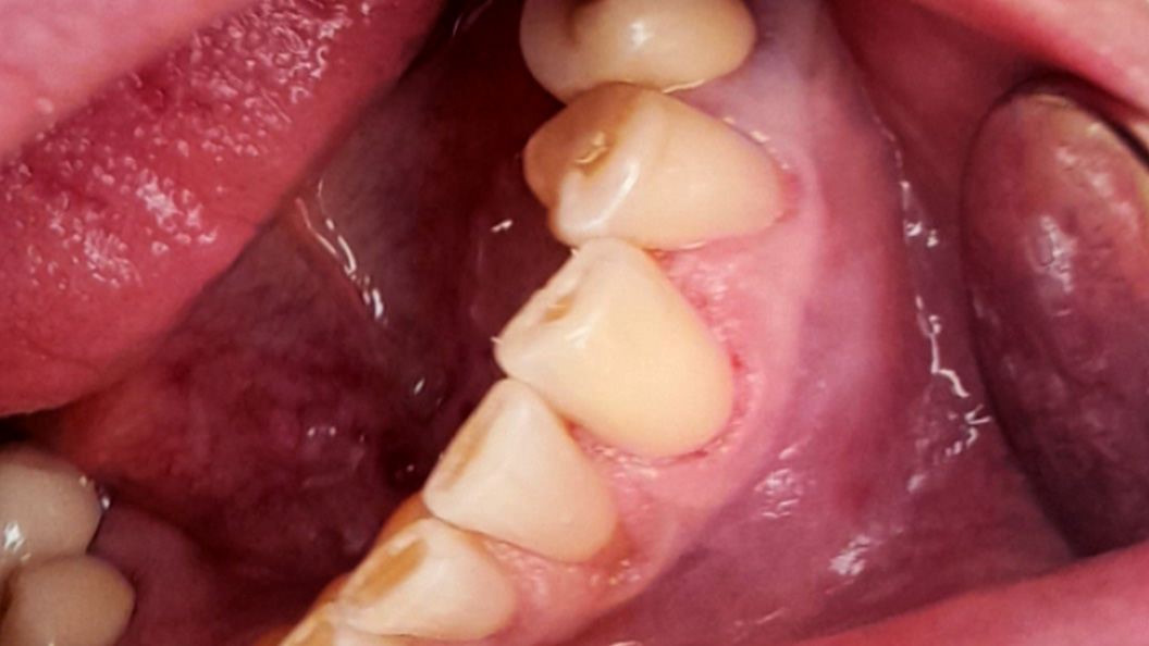 Фото восстановленного зуба