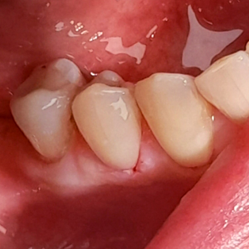 Фото 44 зуба после лечения 2