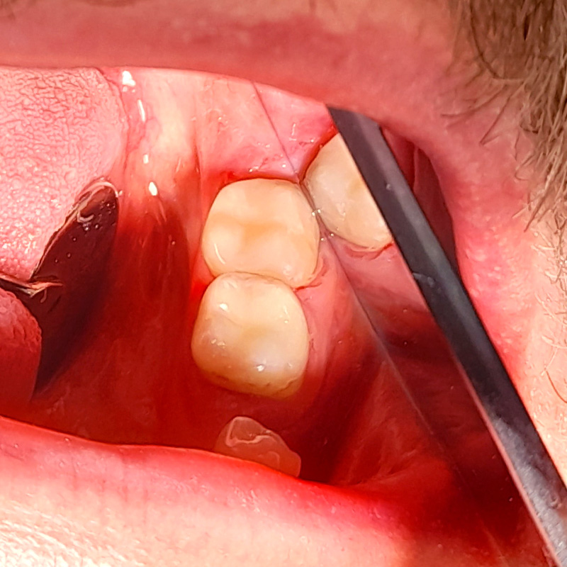 Зубы после лечения с помощью Estelite 2