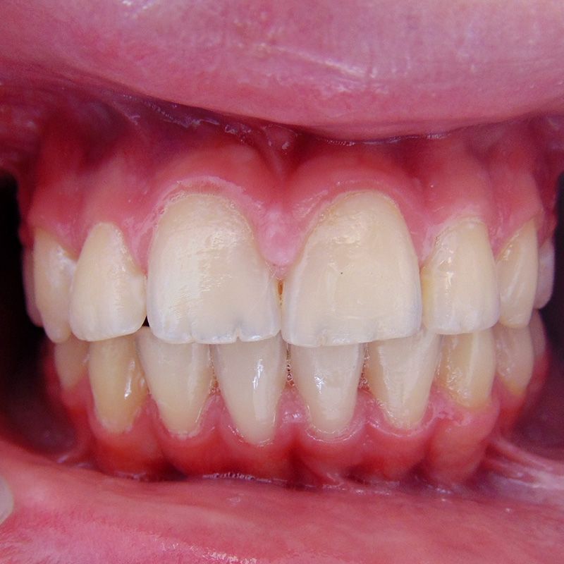 Фото зубов после брекет-системы 2