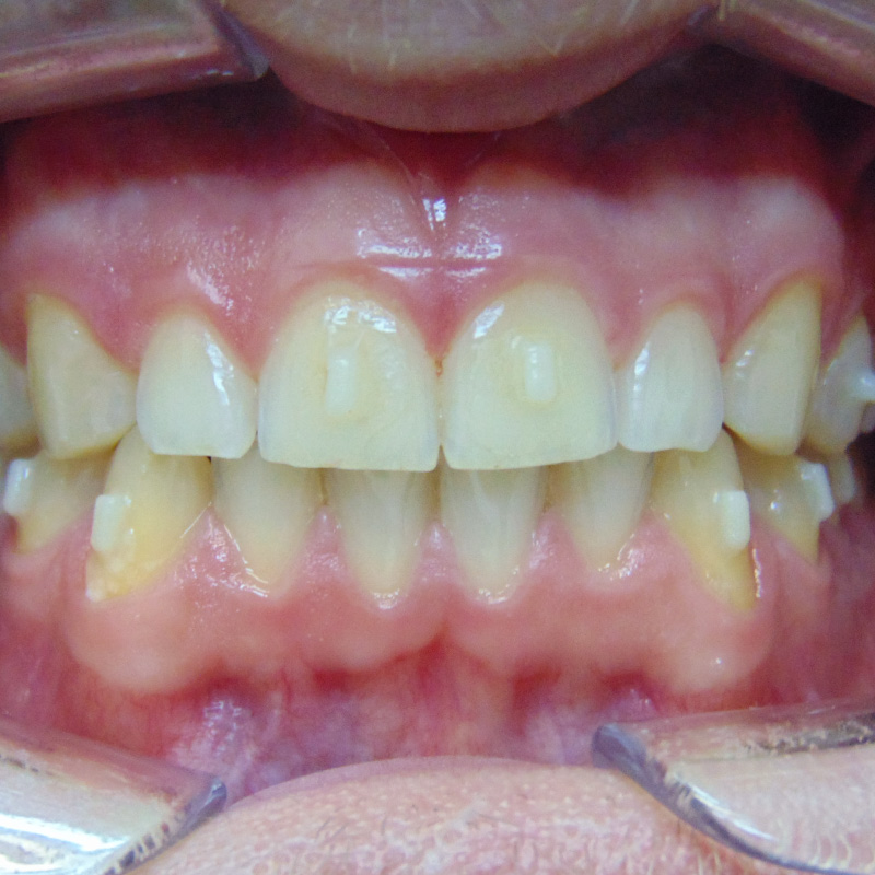 Фото зубов после лечения на элайнерах 2