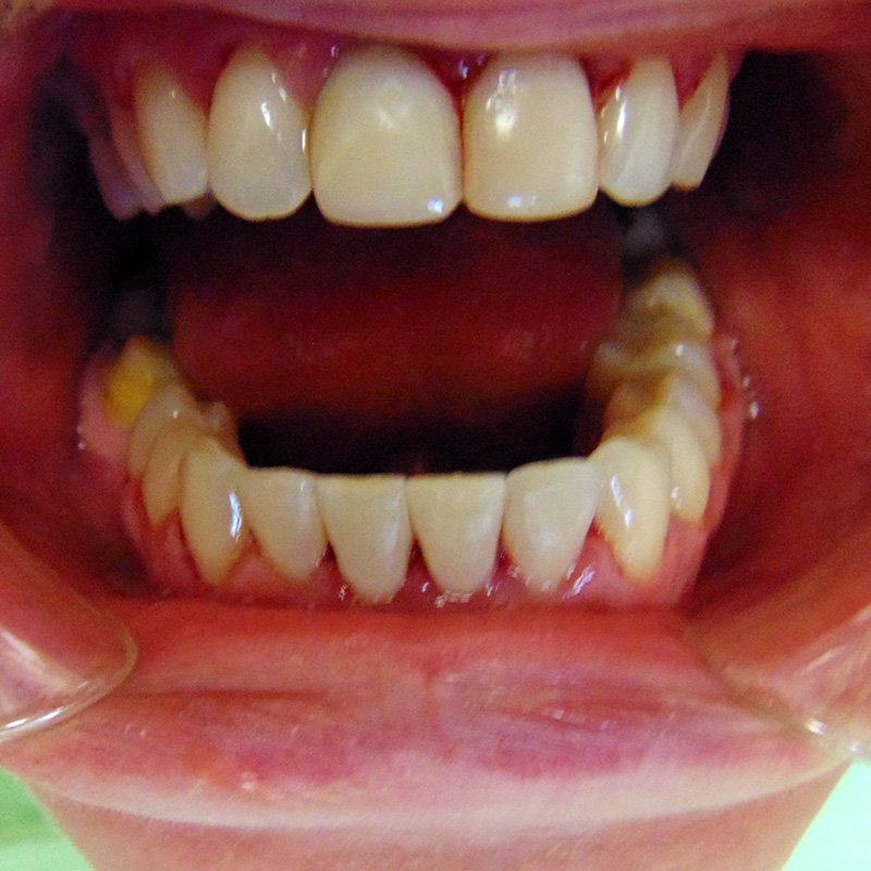 Фото после лечения скрученности зубов 2