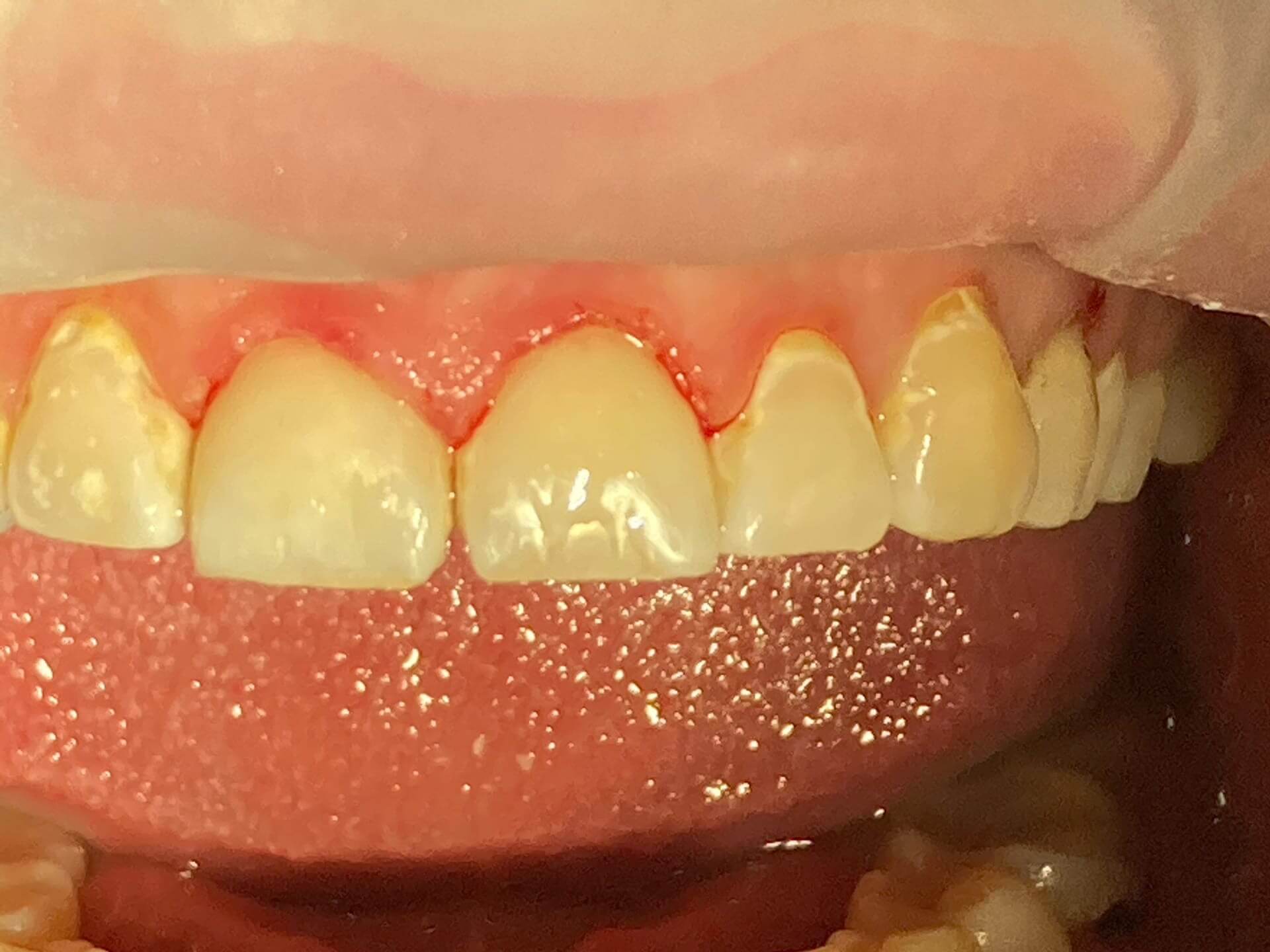 Зубы после лечения кариеса дентина 2