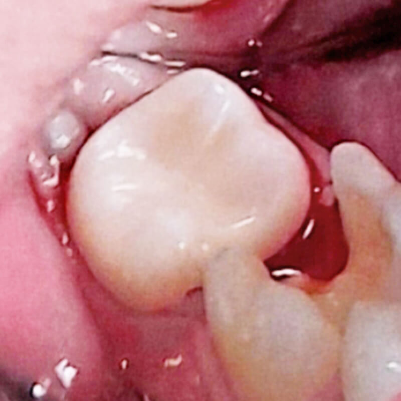Фото 47 зуба после лечения кариеса 2
