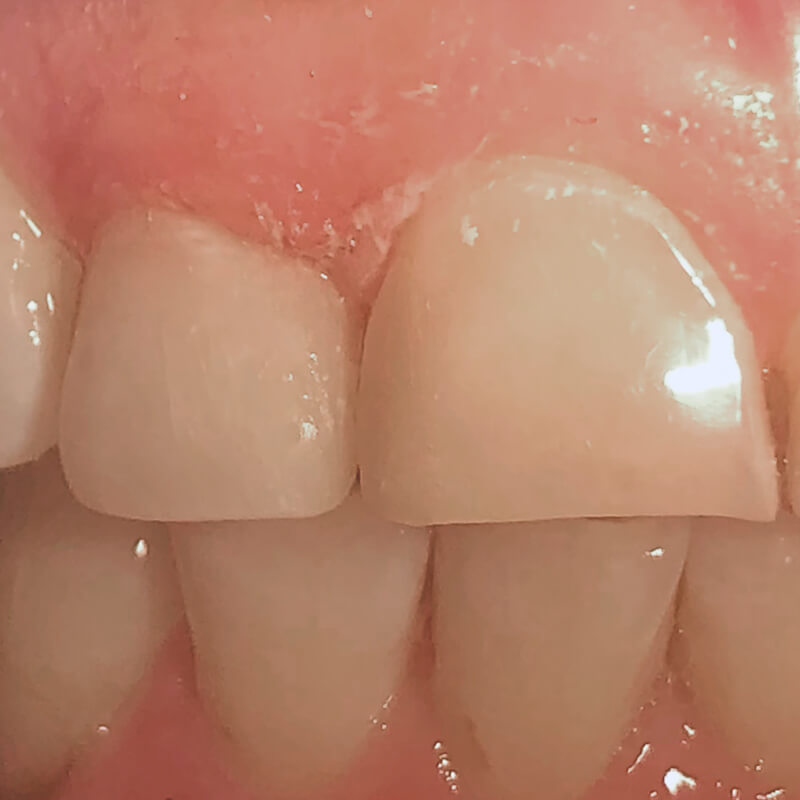 Фото зубов 1.2 и 1.1 после лечения 2