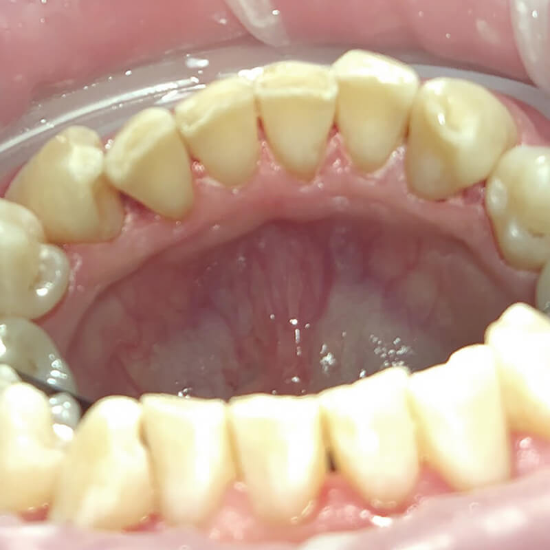 Фото зубов после проведения гигиены