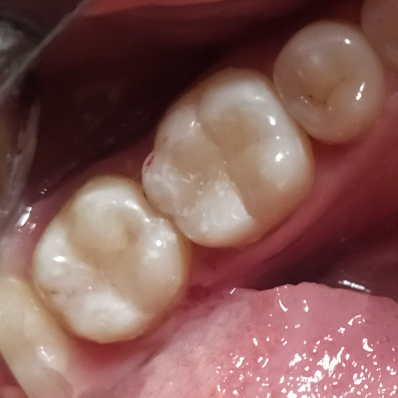 Фото зубов 3.6 и 3.7 после лечения 2