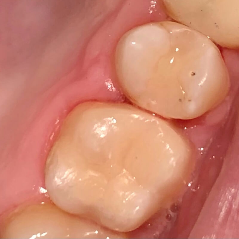 Фото зуба после лечения композитом 2