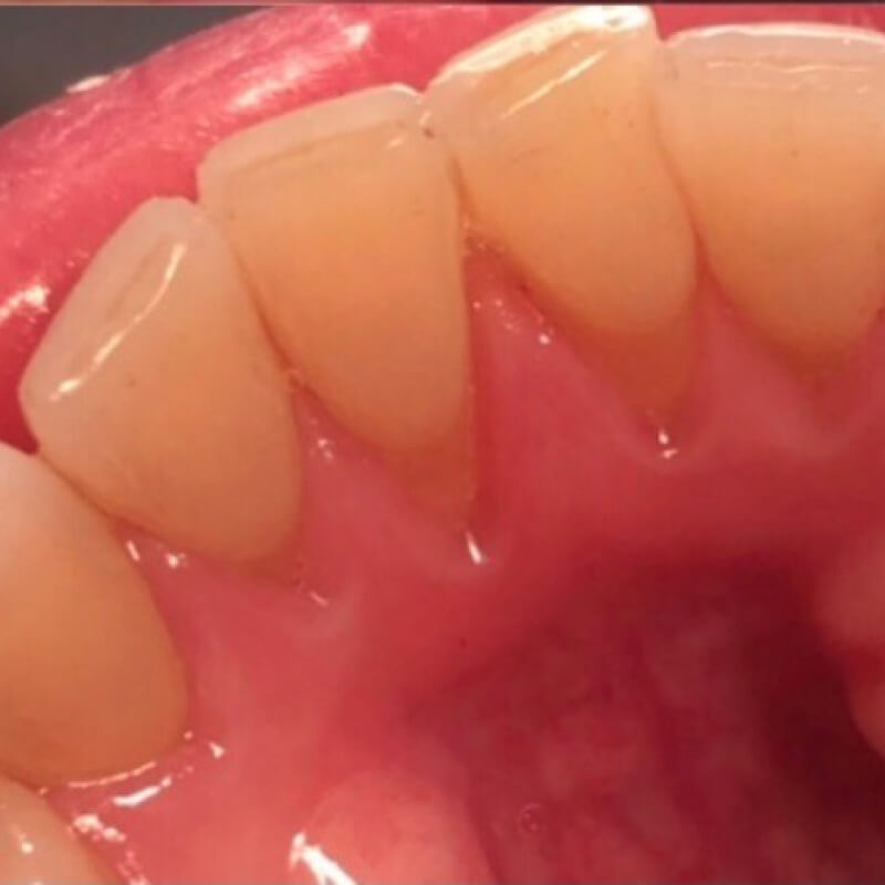 Фот зубов после гигиены 2