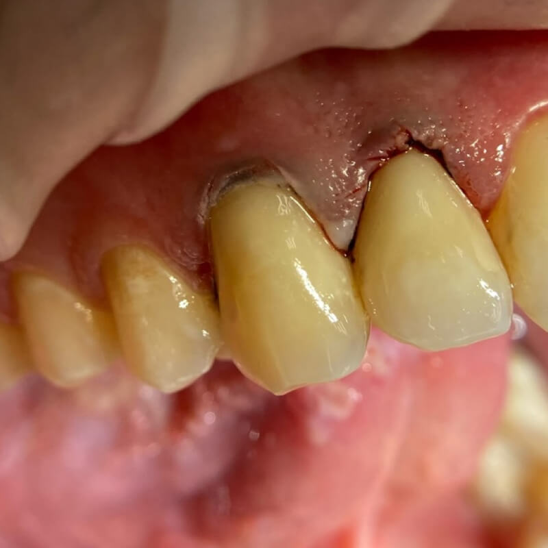 Передние зубы после лечения кариеса 2