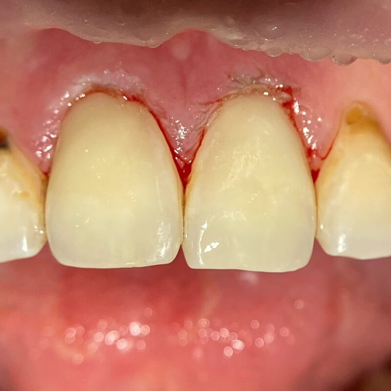 Фото зубов после лечения 2