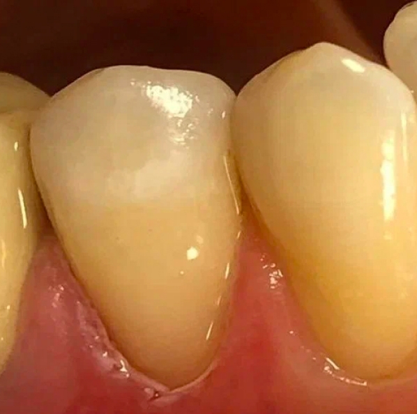 Фото зуба после лечения дефекта 2