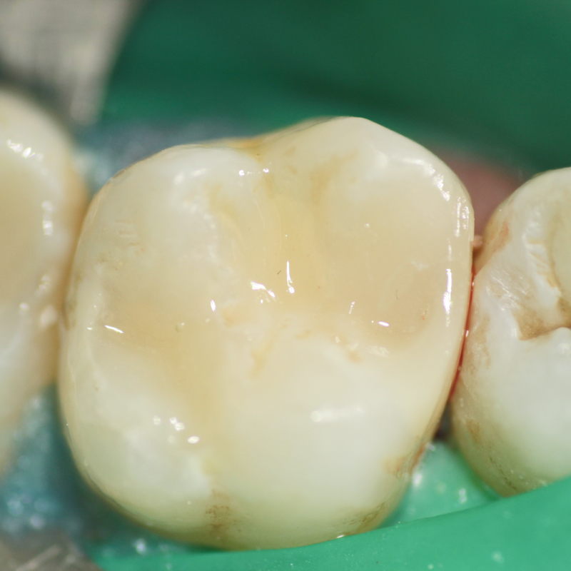Фото зуба после лечения наногибридным композитом 2