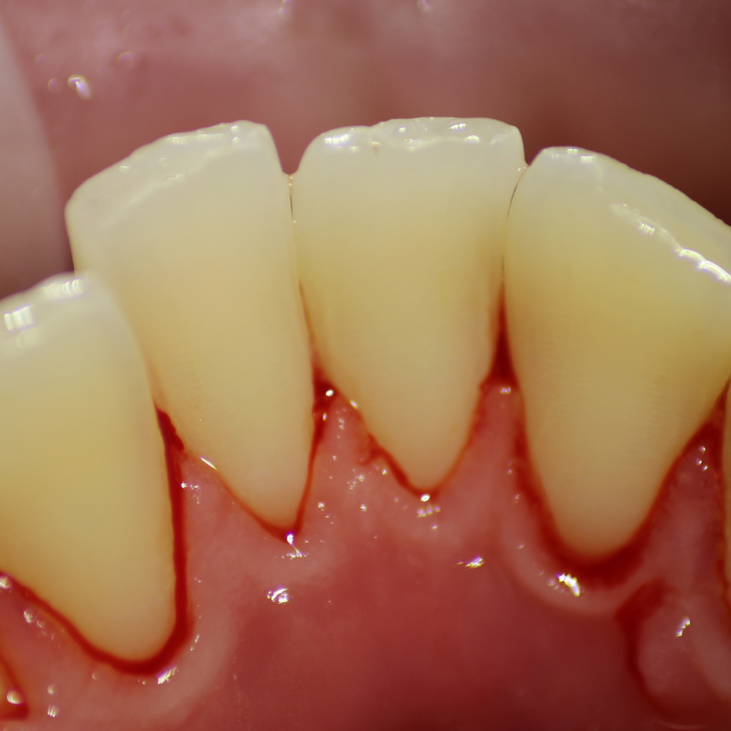 Фото зубов после лечения гингивита 2