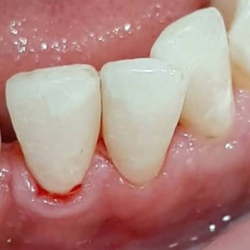 Фото кариеса 3-х зубов после лечения 2